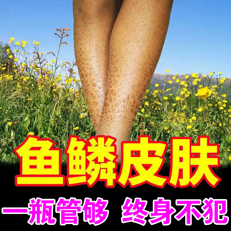 Fish scale skin cream to remove goose bumps fish scale skin disease body milk to treat dry skin peeling moisturizing antipruritic cream