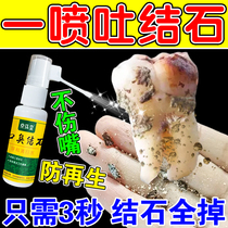 Special spray for removal of dental calculus Quick Quick Dissolving Tooth Stone Fungicide Removal of Tooth Stain Tooth Stain Dental Stains Non Toothpaste