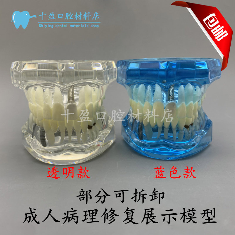 牙科口腔教学模型 可拆卸种植体修复模型 活动牙种植牙 医患沟通
