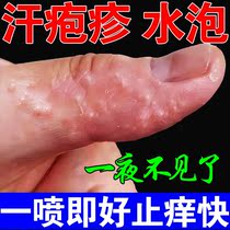 Sweat Herpes hands up small blisters Itch Allergy Itching Hand Foot Tinea Pederi Peel Dry Mycotic Fungal Infection Anti-Itching Spray