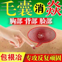 Treatment for hair folliculitis special drug head butt long pimple pussy pussy Pussy Red Lump Red Lumps Cream
