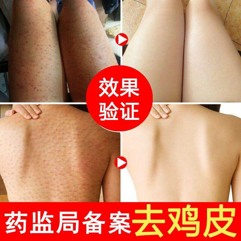 Chicken skin artifact savior hair pore blockage on legs, upper arms and arms pimples hair follicles keratinized melanin