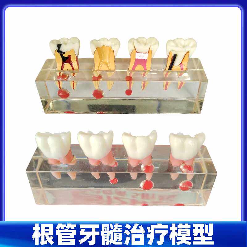 根管牙髓治疗模型牙科口腔教学牙模种植修复病理模型医患沟通模型