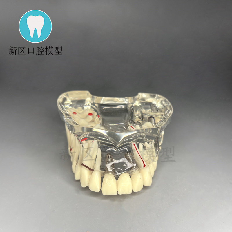 医用牙科口腔教学模型 上半口连桥修复 种植模型龋齿  种植钉医患