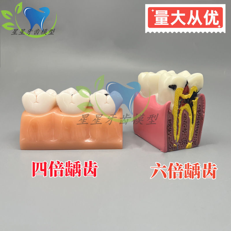 牙科口腔模型 6倍龋齿对比4倍龋齿分解覆发展演变 蛀牙牙齿种植