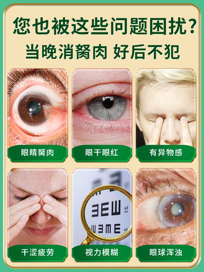 Gotas para los ojos para eliminar pólipos oculares, pterigión largo, visión borrosa, sensación de cuerpo extraño, gotas para los ojos para eliminar los filamentos rojos de la sangre.