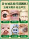 Gotas para los ojos para eliminar pólipos oculares, pterigión largo, visión borrosa, sensación de cuerpo extraño, gotas para los ojos para eliminar los filamentos rojos de la sangre.