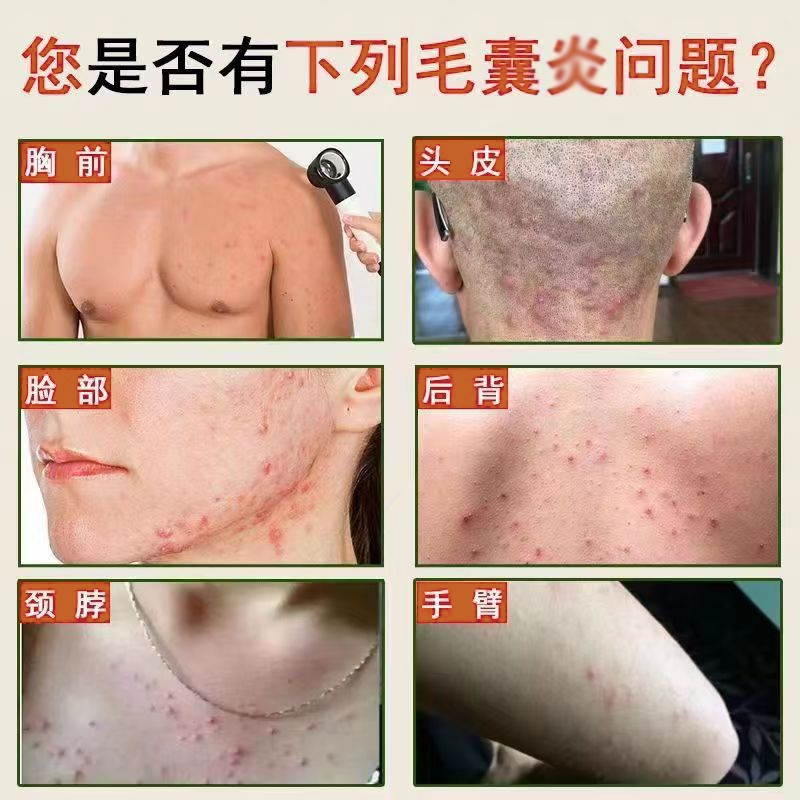 【甜纪毛囊安】官方正品，解决你的毛囊烦恼，全身适用！🌟