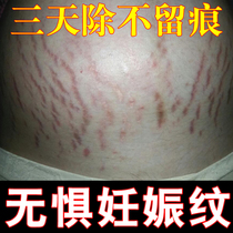Quickly repair growth marks stretch marks eliminate stretch marks tighten belly dilute fat lines repair cream