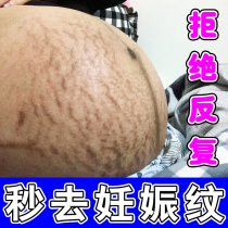 Stretch mark elimination stretch mark tightening and belly effective ointment to treat pregnant womens belly waist and abdominal growth lines.
