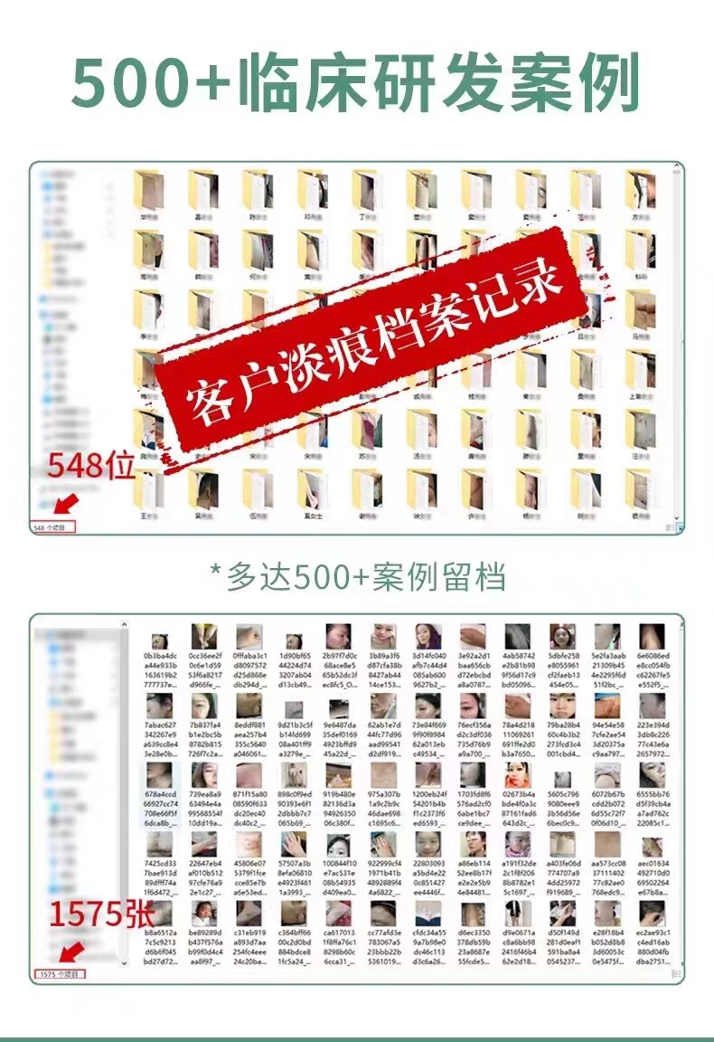 Убрать растяжки массажер 【日本爆款热卖】日系疤痕滚珠修复剖腹产增生凹凸疤痕全身 OTHER