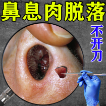 Nasal polyps (will fall off automatically without surgery) sinusitis nasal congestion turbinate hypertrophy clearing nasal polyps rhinitis and blockage