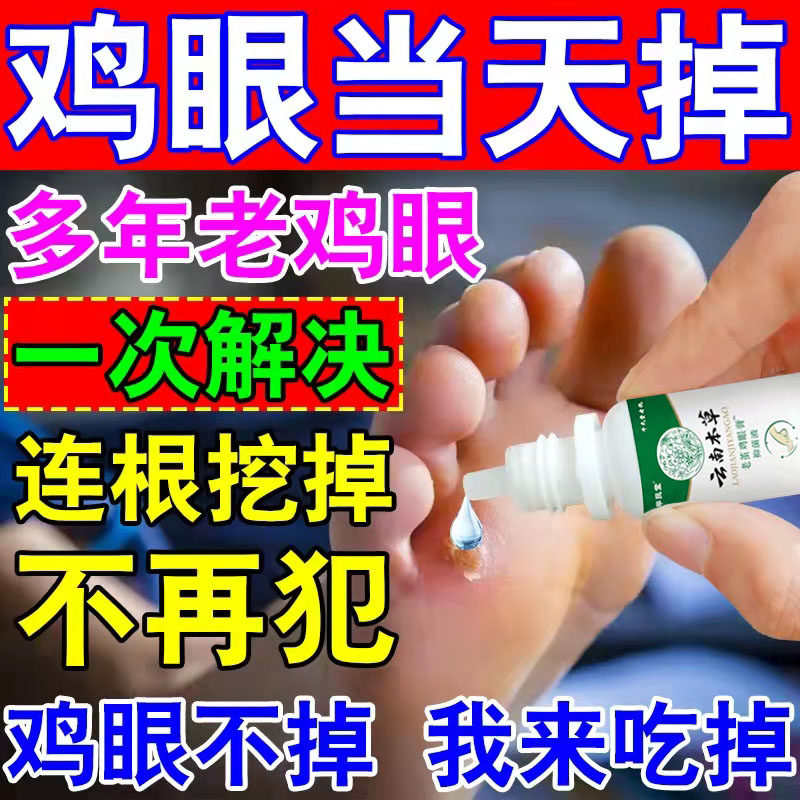 Corn ointment paste corn syrup to remove root meat thorns to remove foot toe calluses walking pain pain special