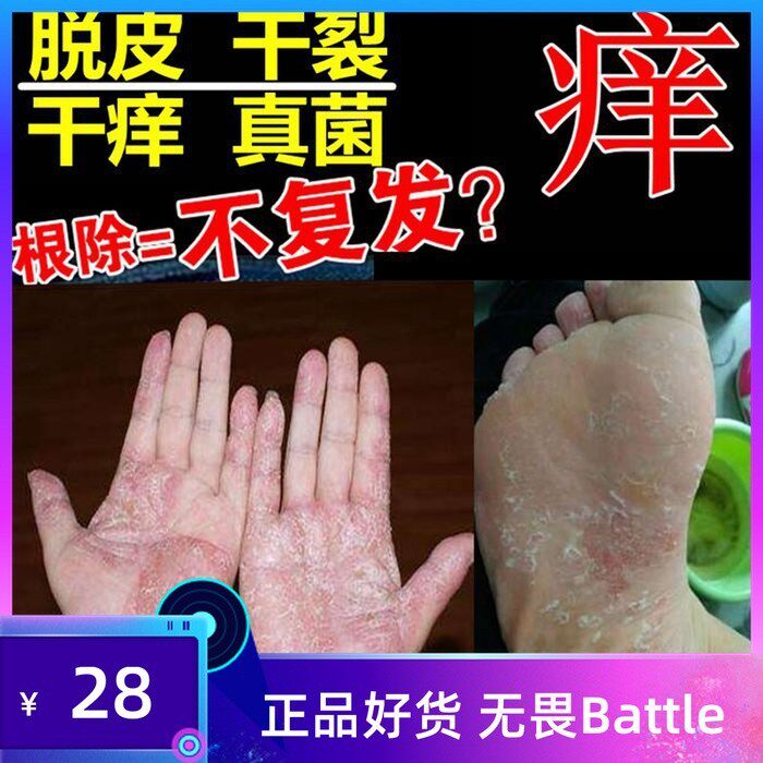 Treatment of peeling hands and feet, dry cracked toes, blisters, itchy skin, antibacterial and antipruritic ointment