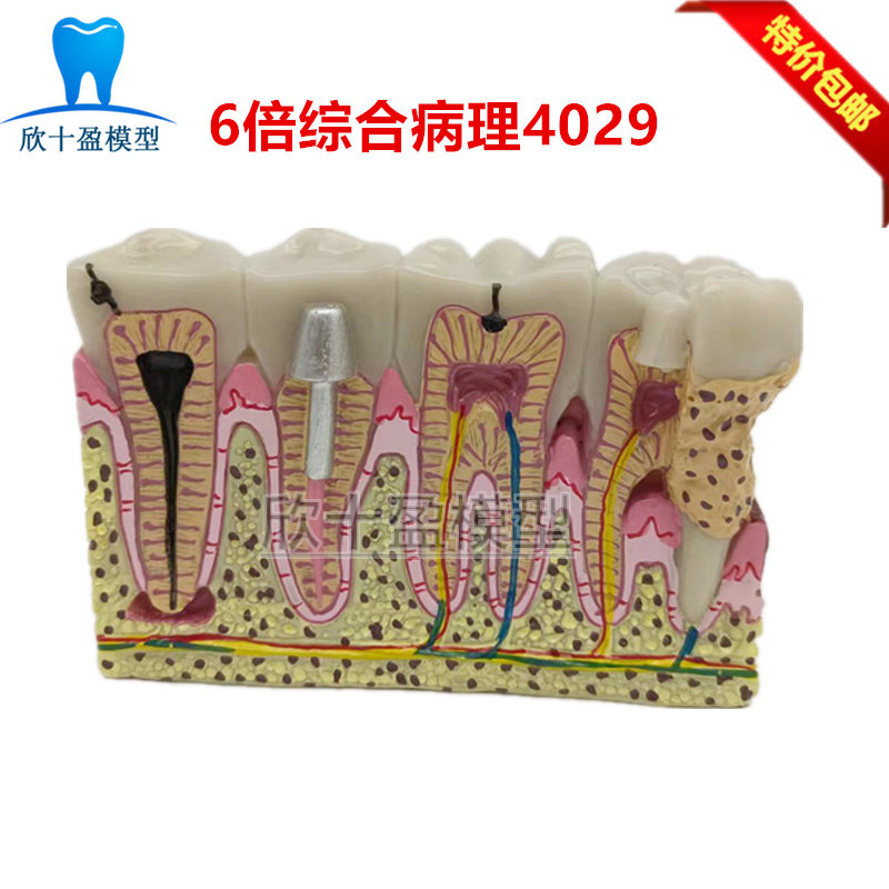 牙科口腔6倍综合病理模型 龋齿解剖根管及牙神经展示教学模型4029