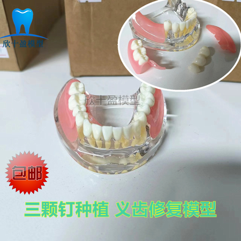 牙科口腔展示义齿种植与修复模型 三3颗钉种植模型微型种植 包邮