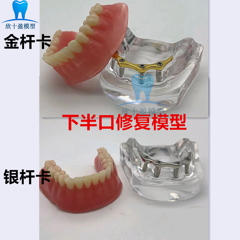 牙科口腔模型银杆卡修复模型半口种植修复模型金杆卡种植教学模型