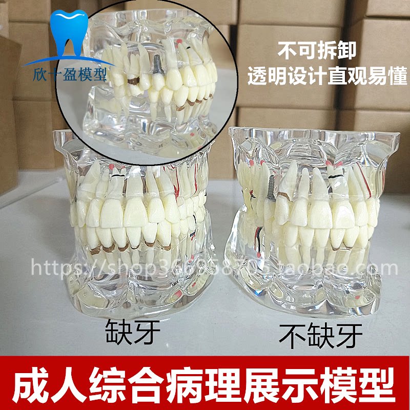 牙科材料 牙齿病理模型成人全口牙模型牙模医患沟通教育教学 牙模
