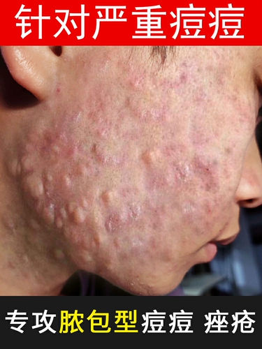 Какими лекарственными лимфатическими узлами являются прыщи на поверхности прыщей на лице неоднократно на лице