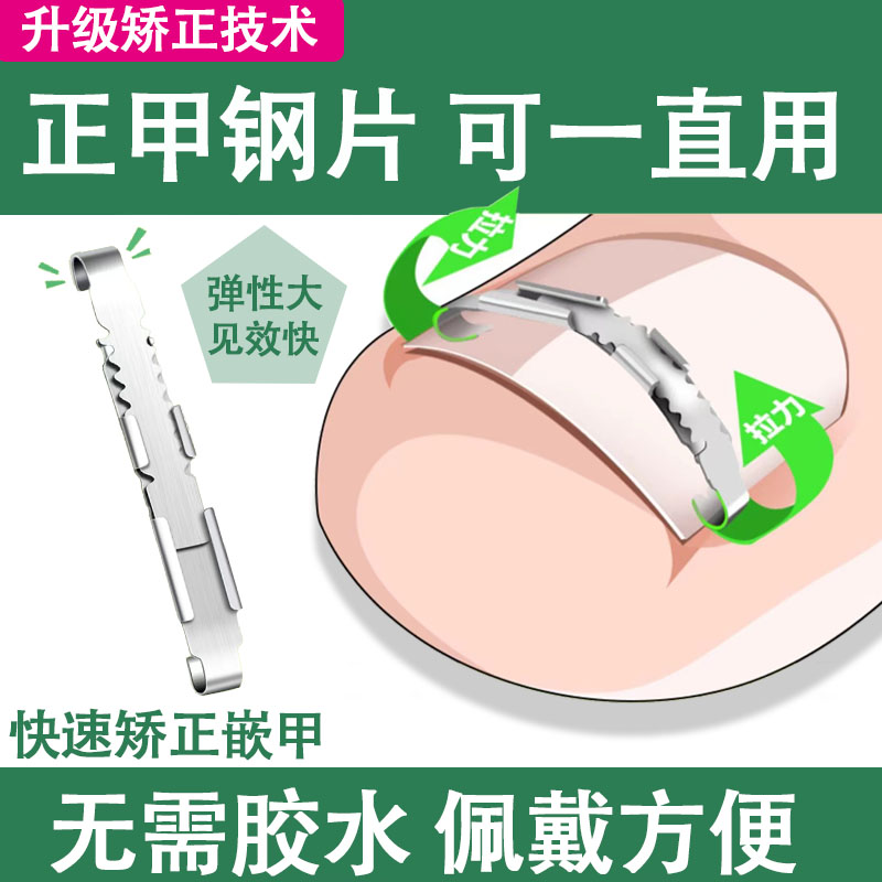 新甲沟矫正器正甲扣正甲贴片嵌甲脚趾甲卷钳纠正神器扎肉专用德国