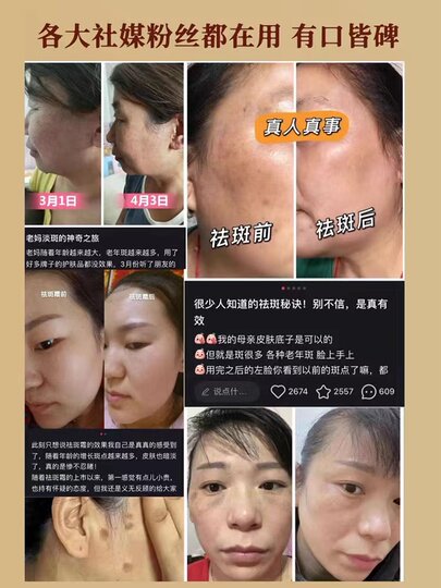 Powerful Removal of Age Spots, Special Cream for Hands and Face to Remove Melanin, Genuine Ointment for Removing Chloasma for the Elderly