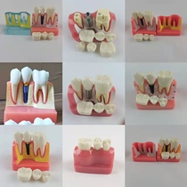 Dental pathology model with bridge repair and detachable oral teaching dental implant doctor-patient communication tooth preparation model