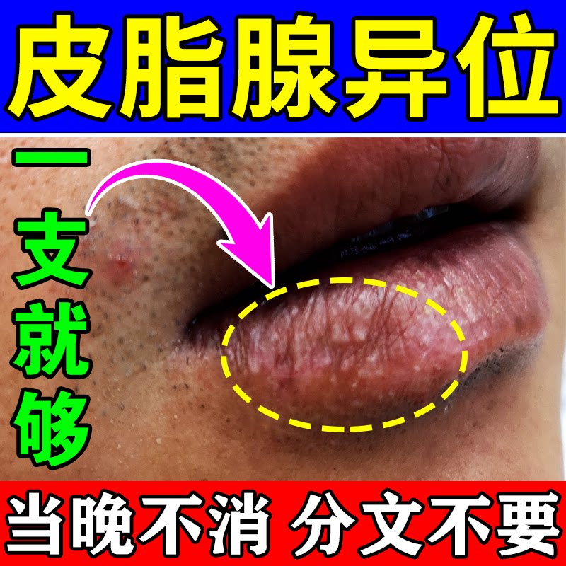 Sebaceous adenopathy lips) dry, cracked, peeling, blistering, dead skin mounds, long fat particles, small white dots, pimple medicine