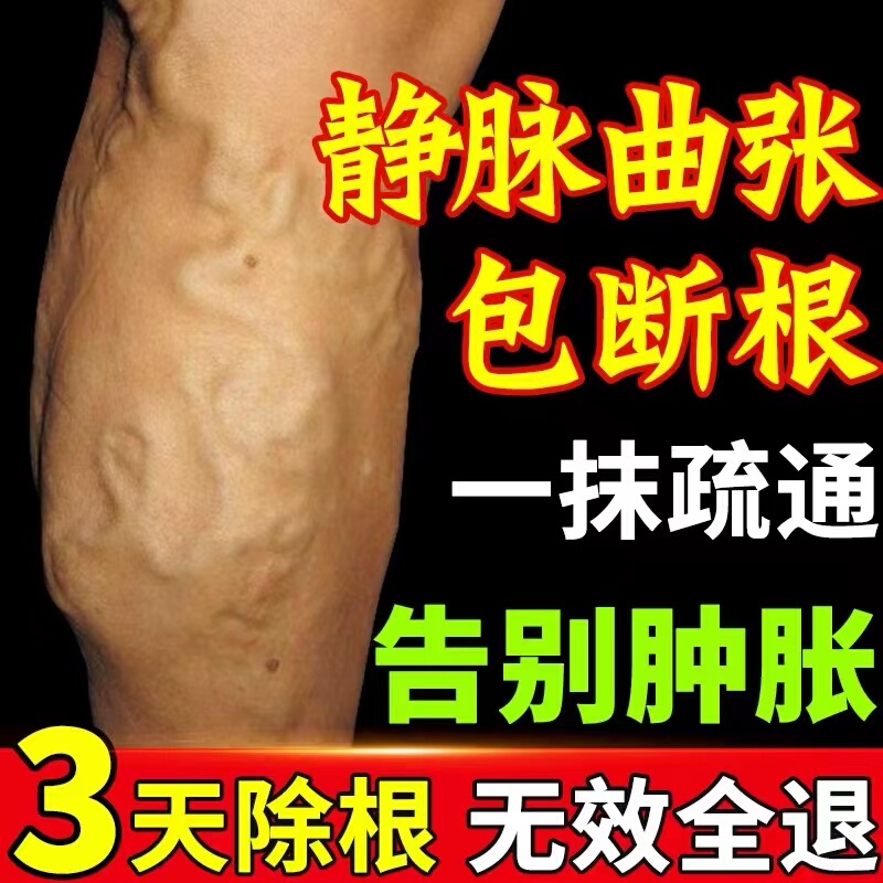 Specialized Ointment for Treating Varicose Veins, Effective in Treating Raised Veins on the Calves, Swollen Legs, and Genuine Cold Compress Gel