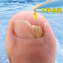 (Watsons best-selling) One drop of it can inhibit bacteria without removing nails and remove 99% of gray potassium fungi. If invalid return guarantee