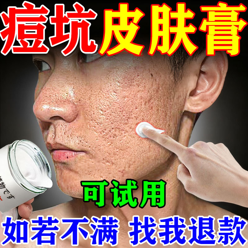 Repairing Acne Scars and Pits for Men and Women, Filling in Acne Marks, Hair Scars, and Large Pores, and Regenerating Skin with a Repairing Cream