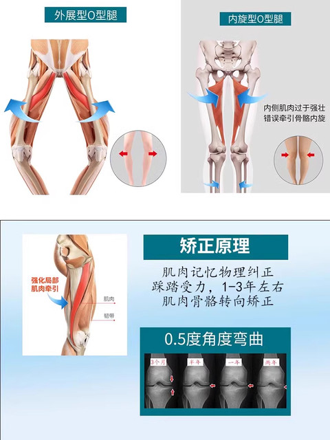 Insoles for Correcting Splayed Feet, O-Shaped Legs, High Outside and Low Inside, Calf Valgus, Foot Valgus Correction Device for Children and Adults