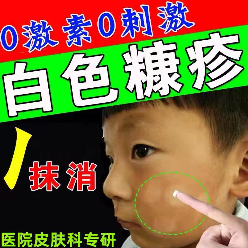 Children's white brash rash face with white patches of patches diluted color plaque anti-itching bacteria to root