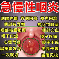 Japanese pharyngitis chronic exfoliation pharyngitis radical cure special medicine foreign body sensation phlegm and follicle spray specific medicine