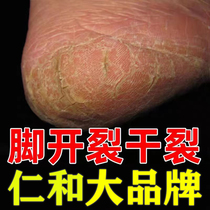Renhe and heel heel skin fungus infected foot cracking cream hands and feet peeling dictators cracking hands and feet