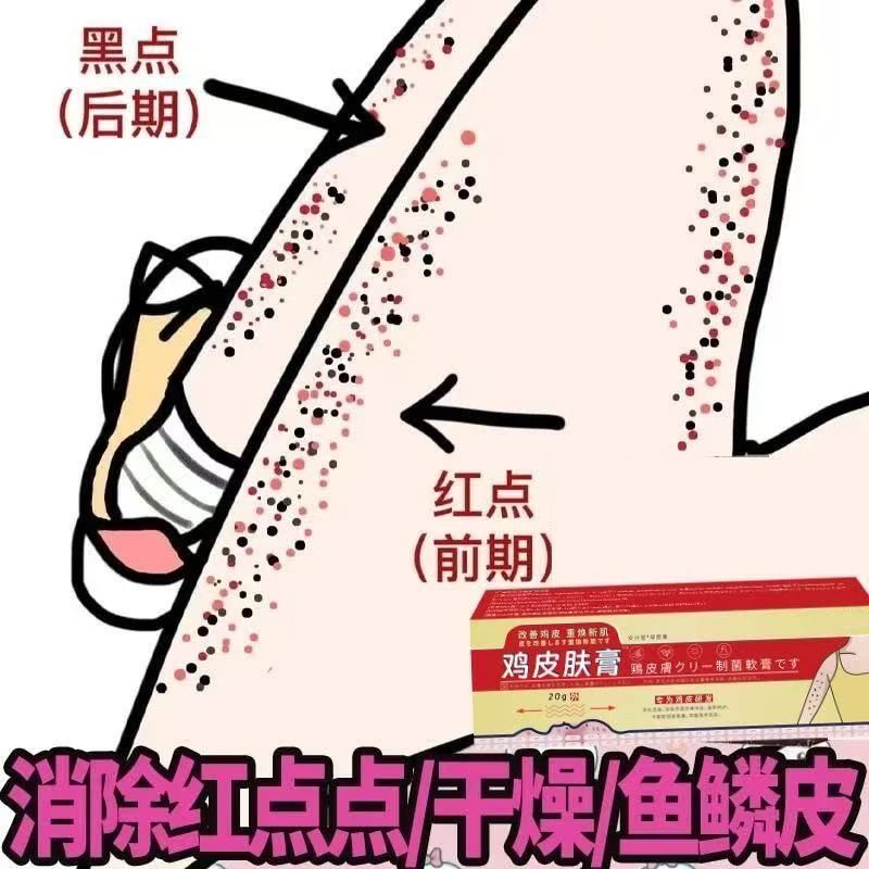 去鸡皮肤膏正品美白腿部鱼鳞皮肤霜干燥手去鸡皮疙瘩脱皮角化神器