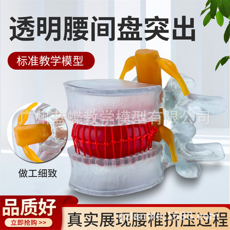 人体脊柱模型脊椎骨头腰椎间盘模具椎体模型突出受压病理骨质教具
