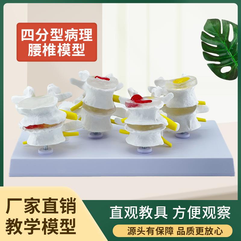 四阶段病变腰椎模型 病理骨骼模型 变形骨骼 病态脊柱脊椎模型