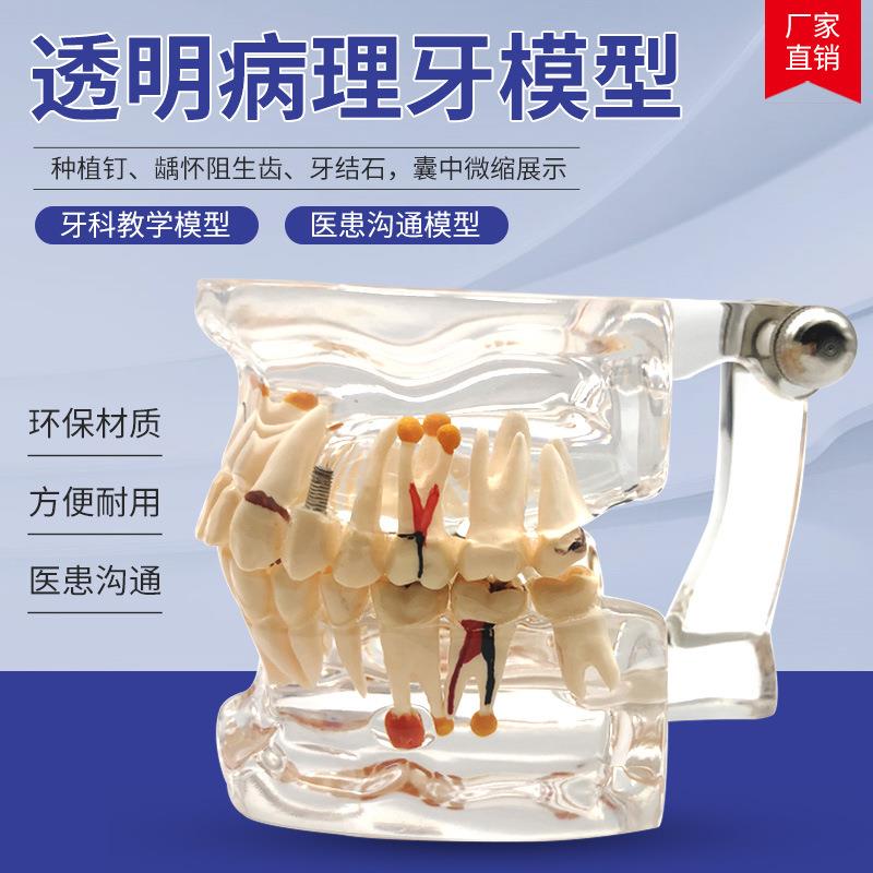 透明全口病理牙模型医学教学综合病理牙齿蛀牙口腔科医患沟通模型