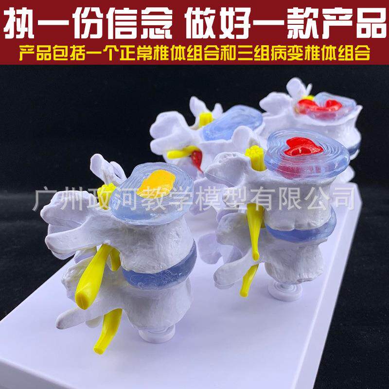 病理腰椎模型四队4对腰间盘病变模型椎间盘病理模型 关节模型