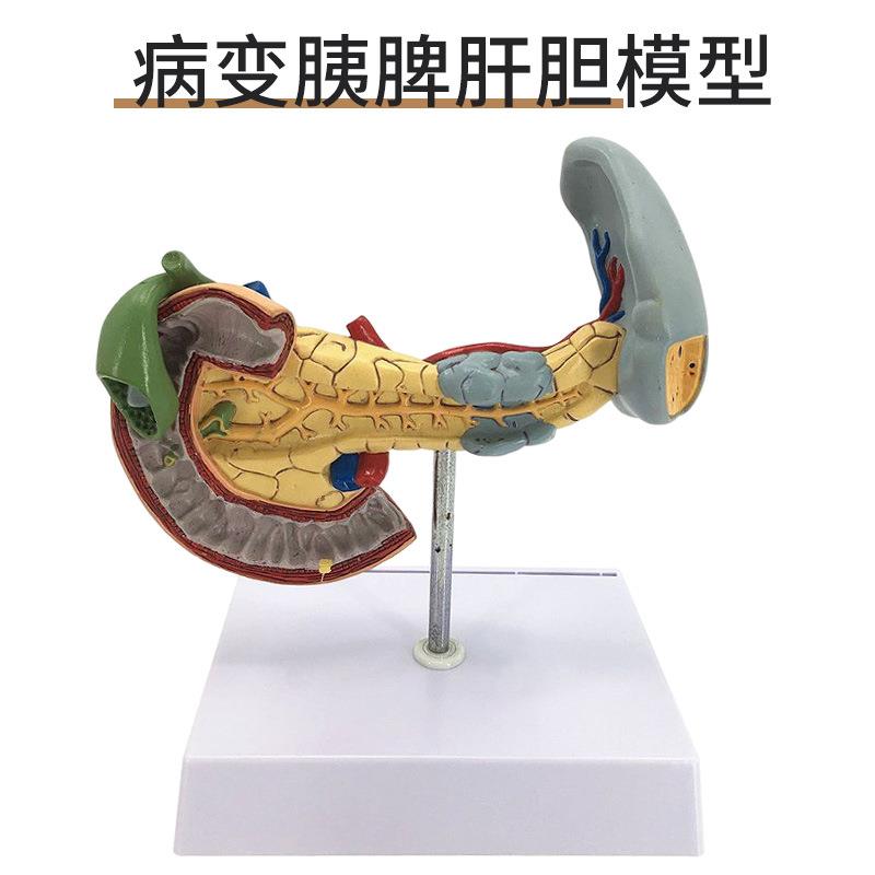 病态脾脏模型 病变胰、脾、十二指肠 胰腺解剖 脾脏模型胰腺病理