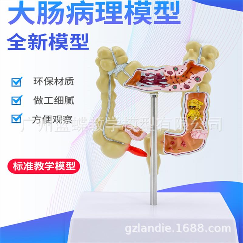 人体小号结肠病变模型 肛肠科消化内科大肠模型 消化科大肠 肠道