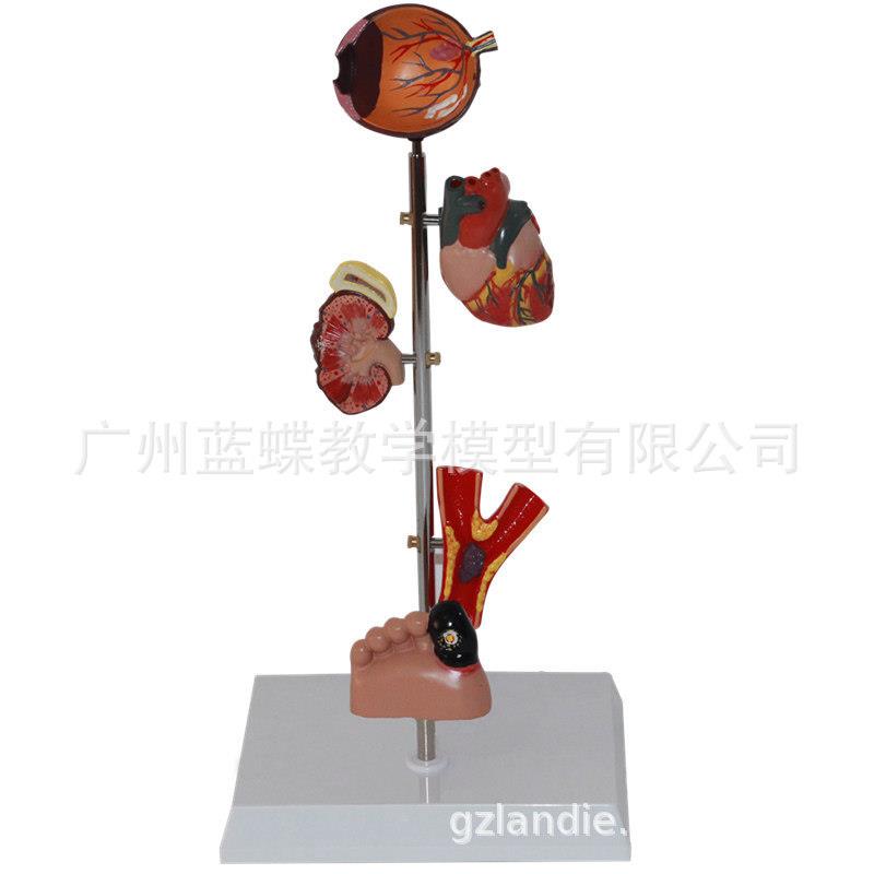 糖/尿病并发症展示模型 高/血压病理病变展示模型 心脏 血管 眼球
