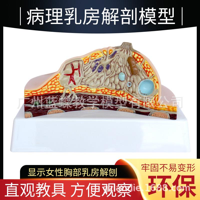 乳房病理解剖模型 女性乳腺解剖 乳腺曾生乳房病变 病态乳房解剖