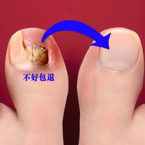 Tongrentang hot sale 100000 no guarantee no repair a drop of it can painlessly remove bad potassium from hands and toes without hurting good potassium easy to use