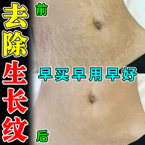 Eliminate growth marks stretch marks remove stretch marks tighten belly reduce obesity marks for postpartum fat people repair and repair light lines cream
