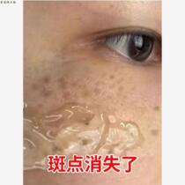 pS (recommended by Watsons) removes dark spots spots and blemishes on your face leaving your face clean and saying goodbye to spots.