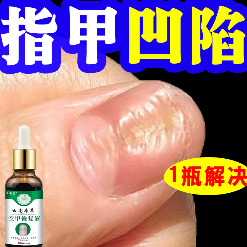 Specialized Repair Solution for Damaged Nails, Including Indentations, Deformities, Unevenness, Shrinkage, Cracking, and Peeling of Fingernails and Toenails