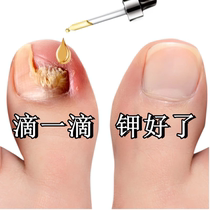 Tong Ren Tang sells 100000 yuan no guarantee no repair (one drop) painlessly removes bad potassium from hands and toes gray potassium nemesis