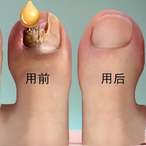 Tong Ren Tang sells 100000 yuan no guarantee no repair (one drop) painlessly removes bad potassium from hands and toes gray potassium nemesis