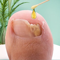 (Watson’s best-selling) One drop no damage no repair antibacterial no nail removal removes 99% of gray potassium fungi
